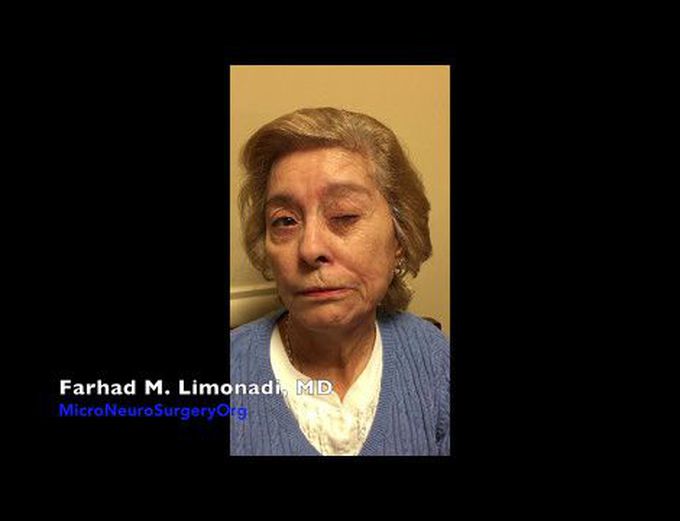 Hemifacial Spasm : Surgical treatment with microvascular decompression (MVD)
