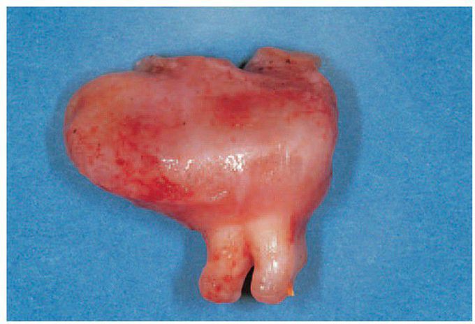 Dentigerous cyst.