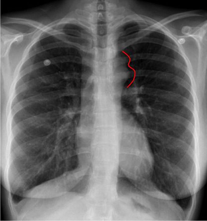 "Figure 3" sign on CXR in a patient with coarctation of aorta