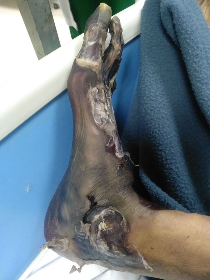 85 yrs old diabetic old ischemic stroke patient
