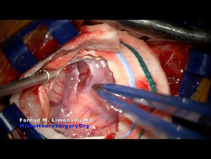 Awake mini-pterional craniotomy: GBM (glioblastoma) and minimally invasive keyhole principles.