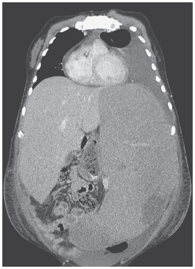 Massive Splenomegaly