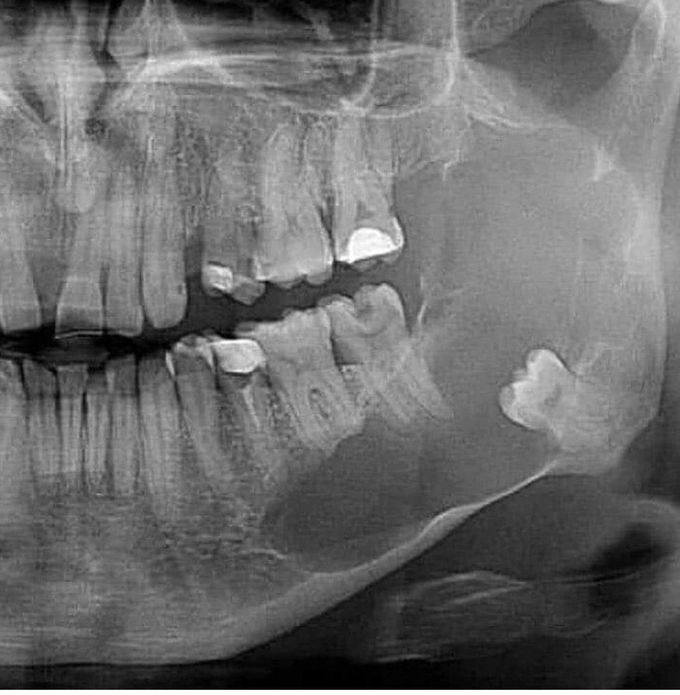 Cyst or Necrosis