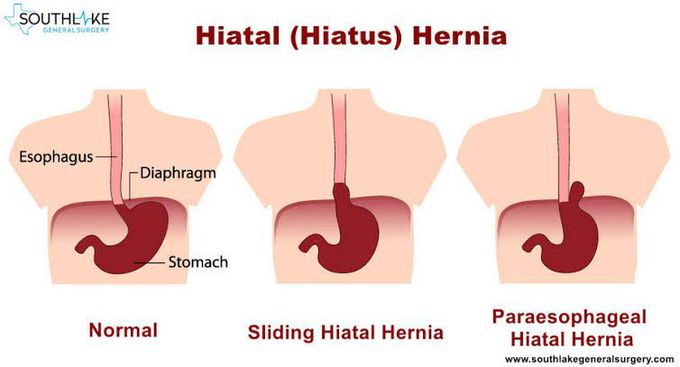 Hiatal Hernia