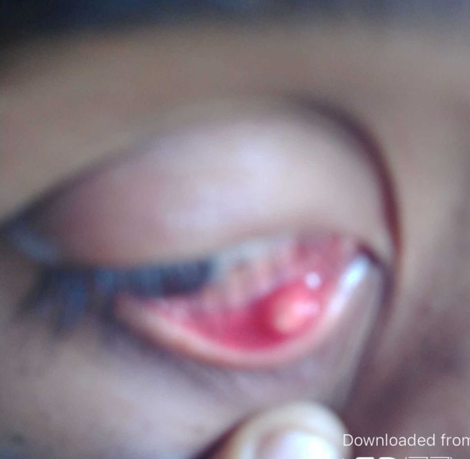 Hi good morning 🌞 iam Sathish I found this lump in my right eye could you please help me with the treatment or home remedies