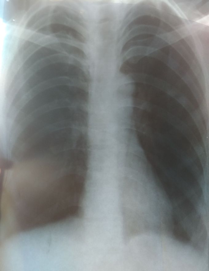Chest x ray medizzy