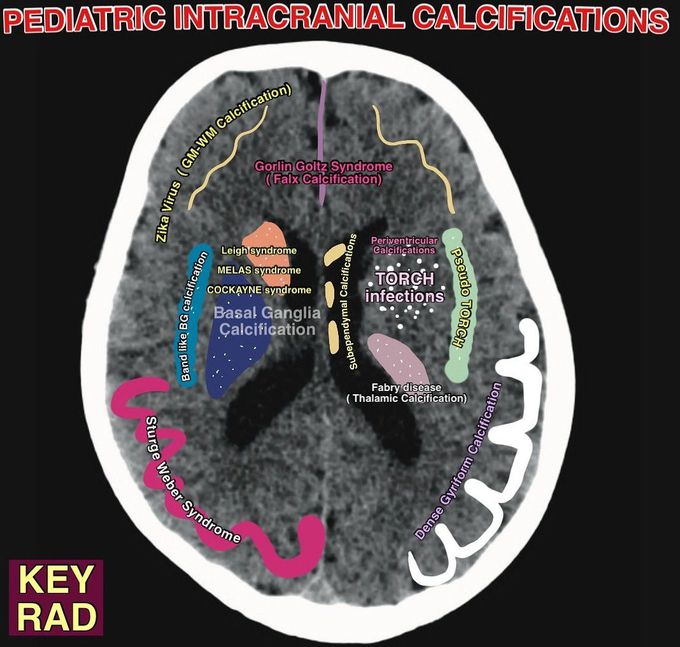 Pediatric Intracranial Calcifications