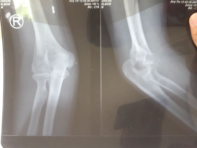 Dis elbow