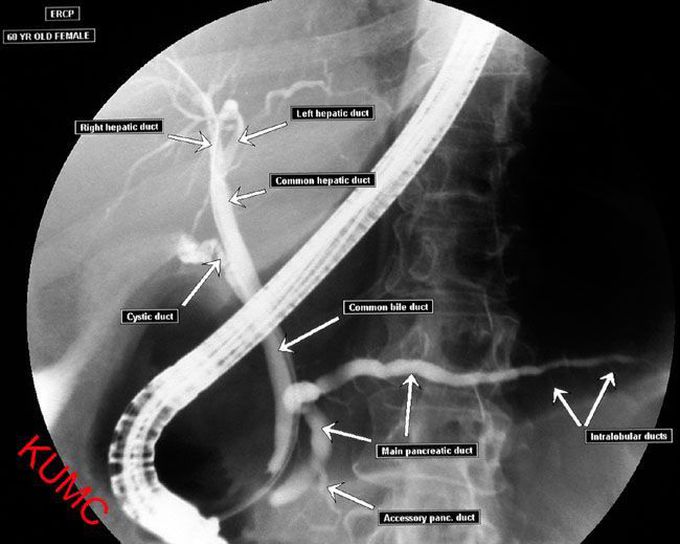 X ray.. ERCP from KUB