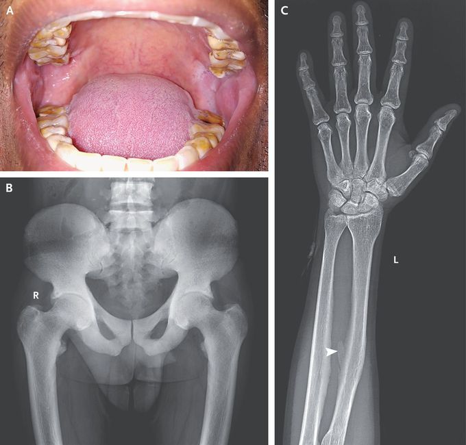 Skeletal Fluorosis