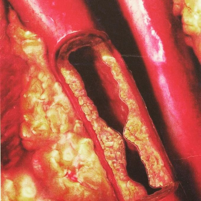 Atherosclerosis