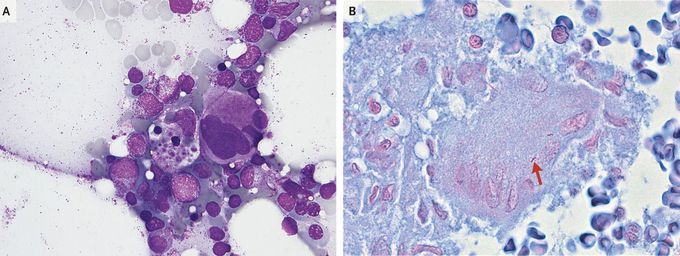 HLH Associated with Disseminated Tuberculosis
