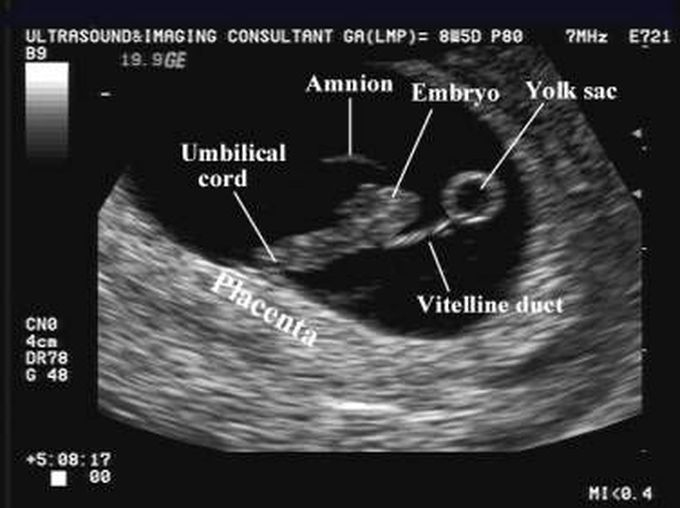 Pregnancy Ultrasound - 1st Trimester
