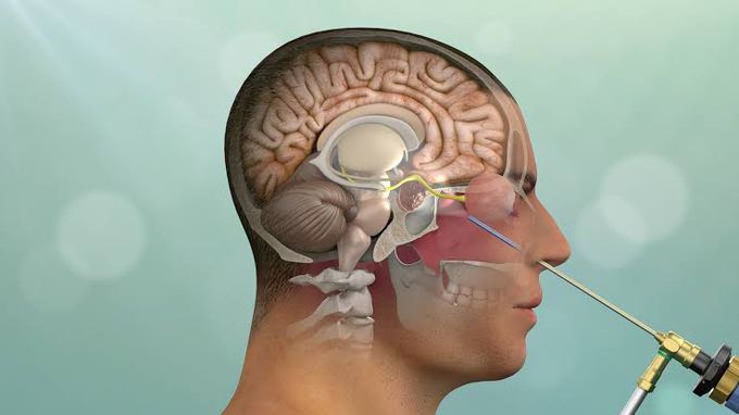 Endoscopic pituitary surgery