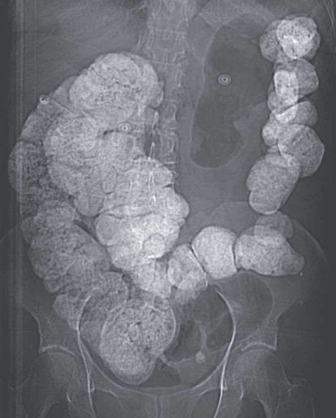 Bismuth Subsalicylate Poisoning