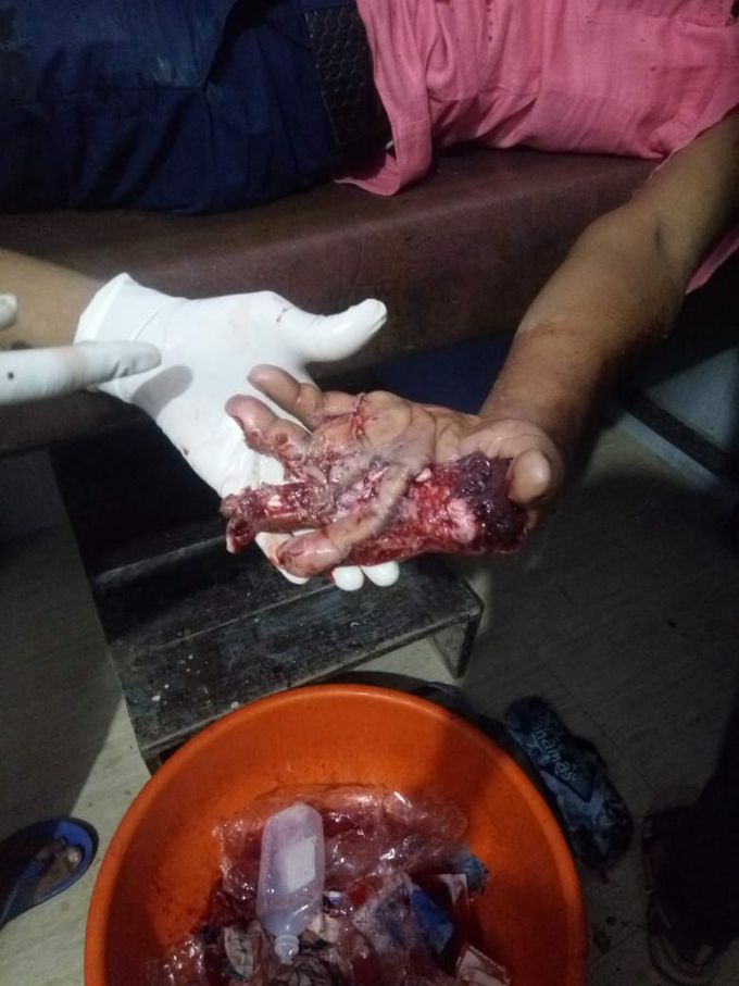 Serious Injury In Hand