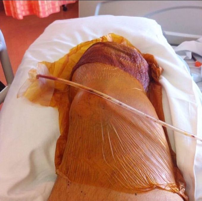 Amputation