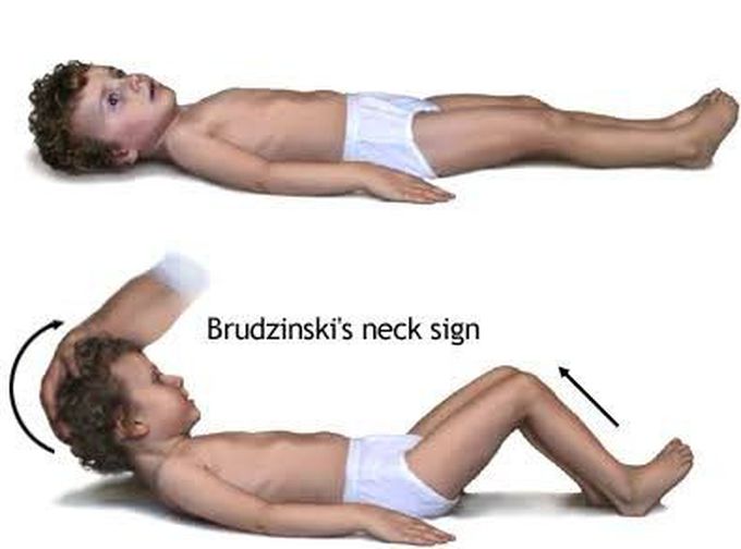 Brudzinski sign