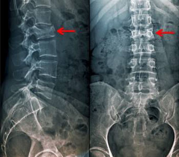 Vertebral fracture(s)
