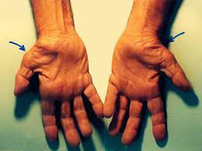 Symptoms of carpal tunnel syndrome
