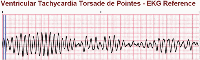 Torsades De Pointes