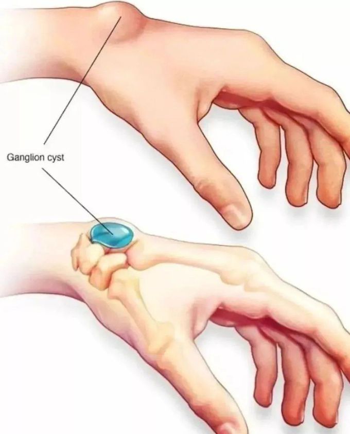 Ganglion cyst