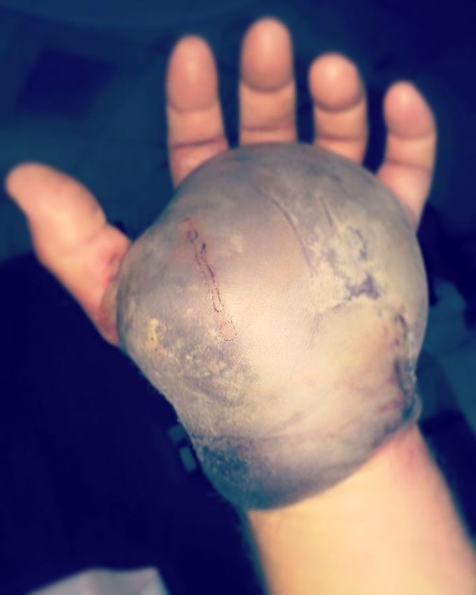 Rattlesnake bite