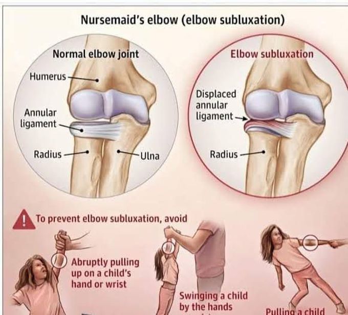 Nursemaid's elbow