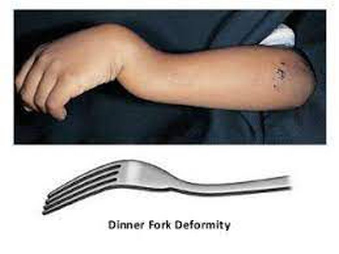 dinner fork deformity