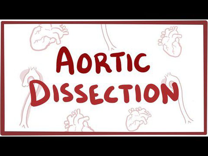 Aortic Dissection