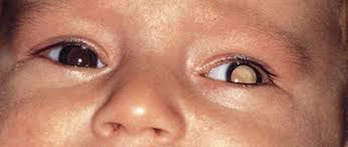 Retinoblastoma