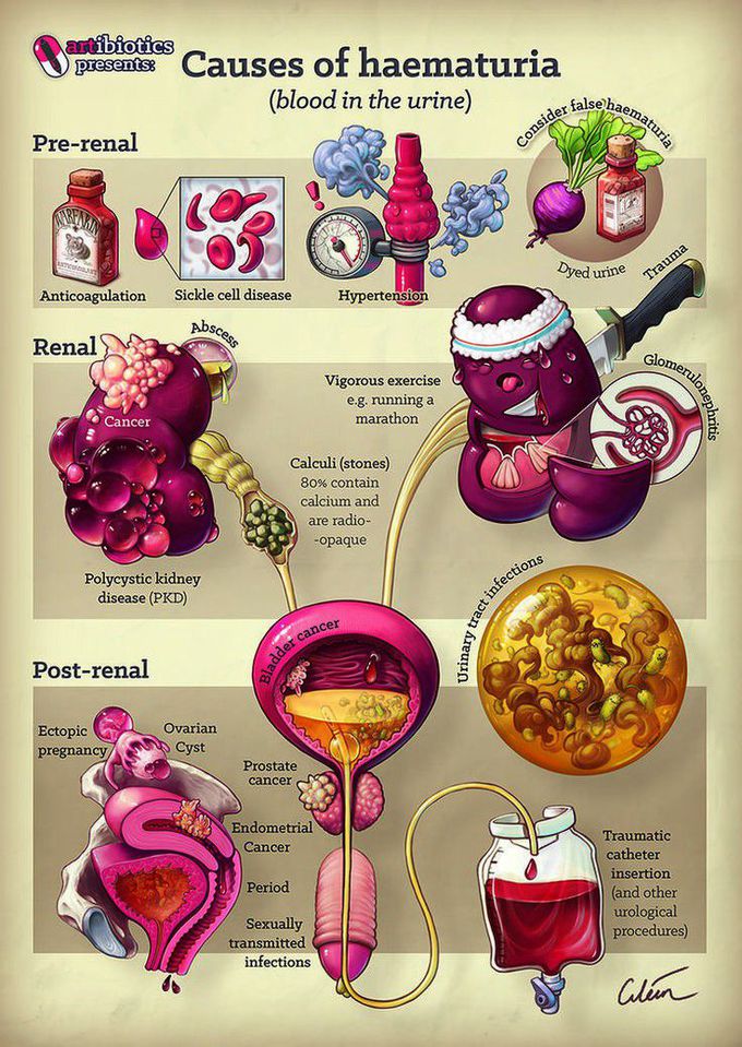 Causes Of Hematuria