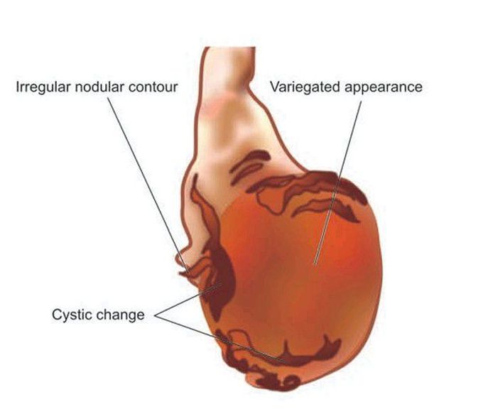 Immature teratoma testis