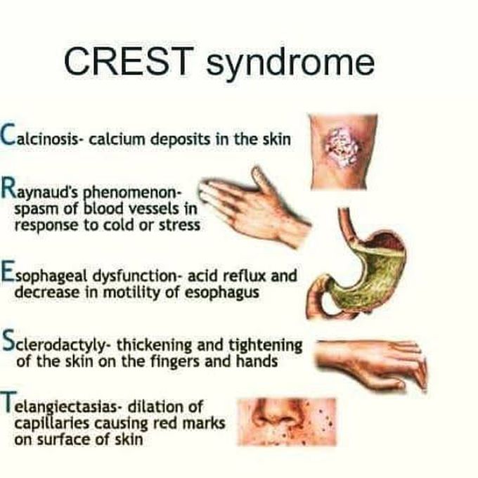 CREST syndrome