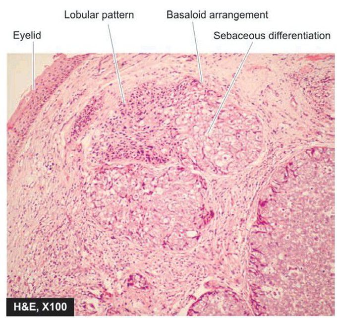 Sebaceous carcinoma.