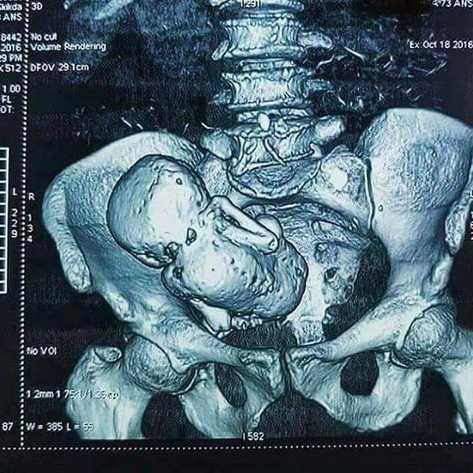 Rare case !