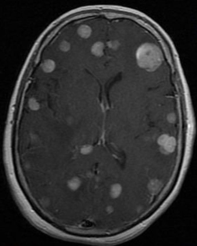 What sequence do you use post contrast for brain mets MR Imaging?&nbsp;