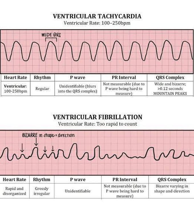 Ventricular Tachycardia and Fibrillation