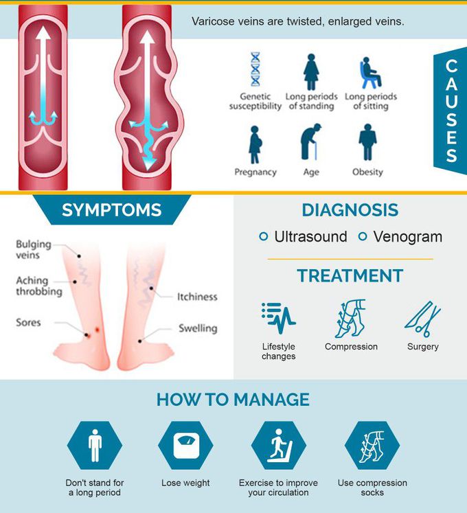 Treatment for Varicose veins