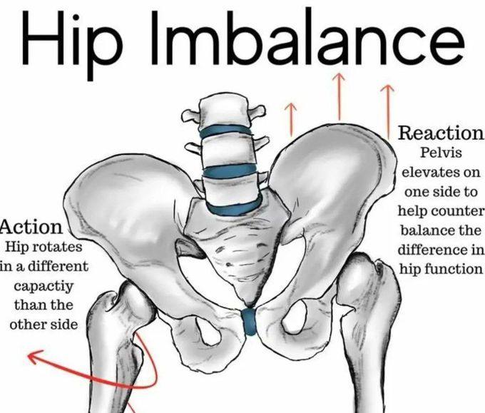 Hip Imbalance