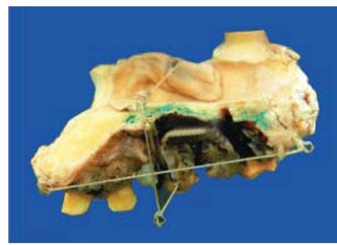 Malignant melanoma of the oral cavity