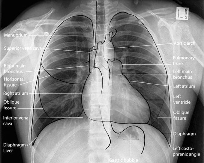 Chest X ray