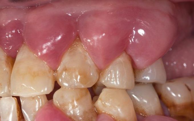 What causes a gum abscess? - MEDizzy