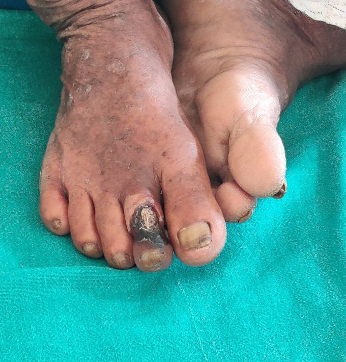 Gangrene foot