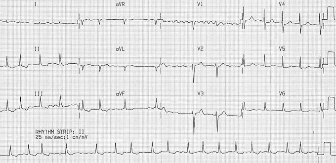 Management of Atrial Fibrillation