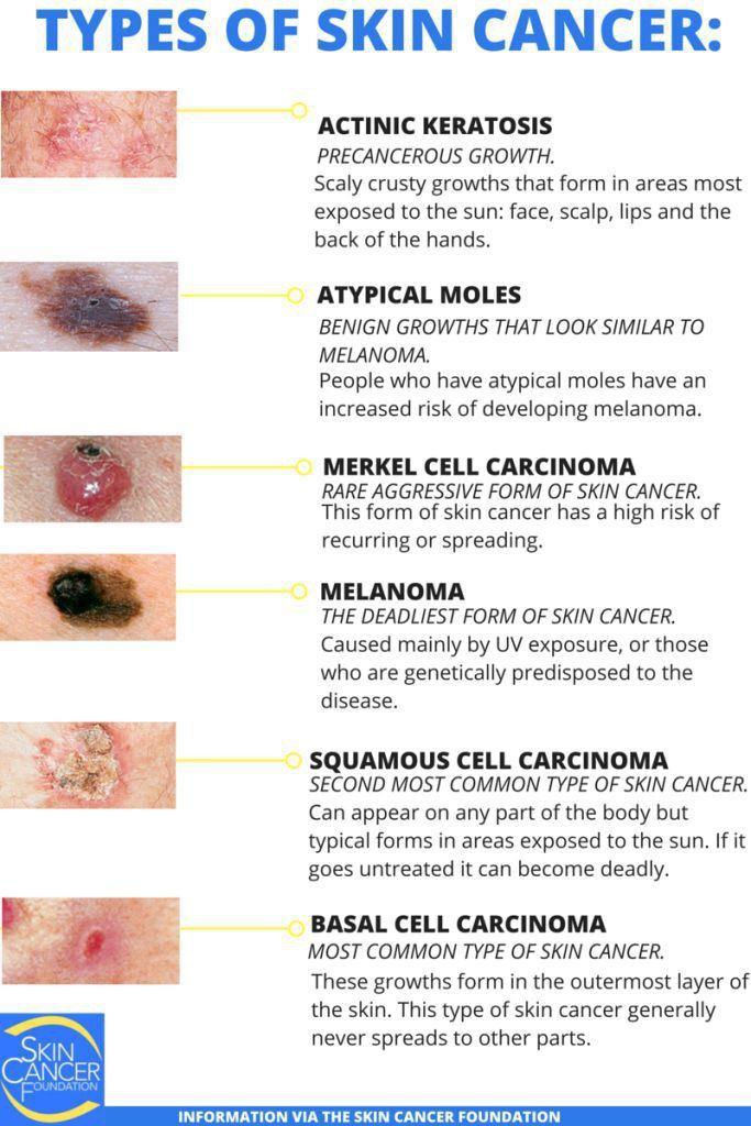 Skin cancer - MEDizzy