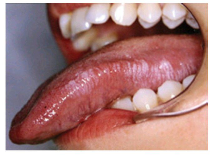 Hairy leukoplakia