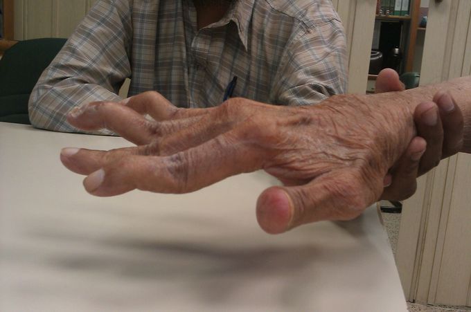 Name the deformity and the condition in which it is seen ?
