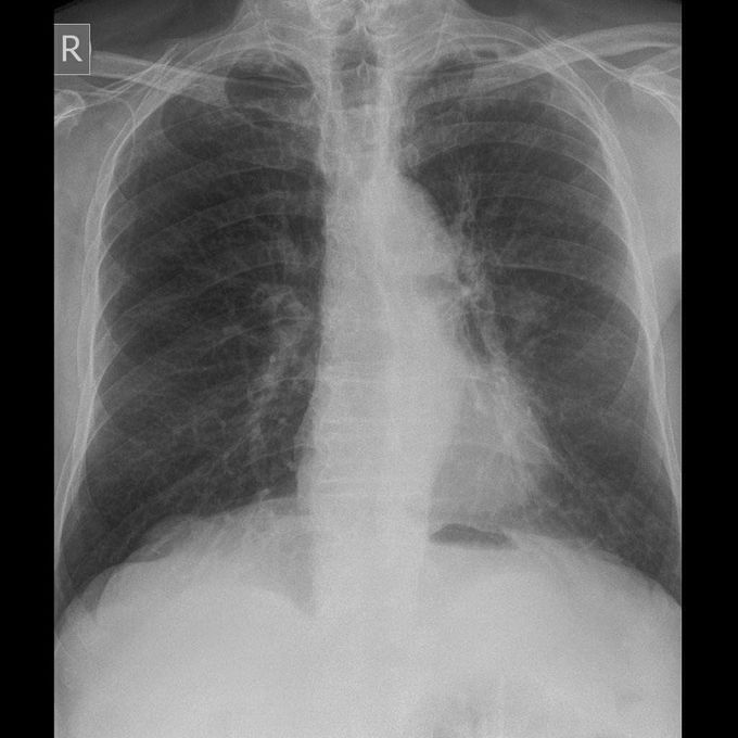 Chest X-ray
