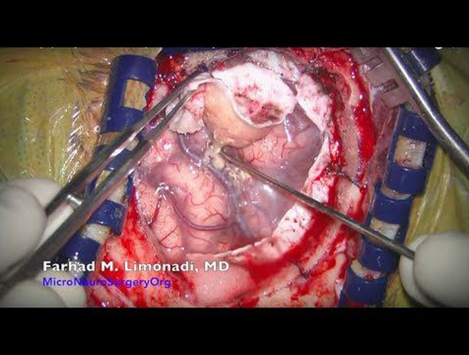 Brain Surgery: Surgical removal of right frontal meningioma